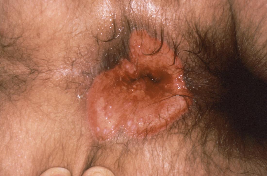genital herpes on anus. Image credit: CDC, 1986.
