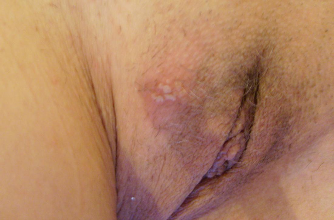 Genital herpes on vagina. Image credit: Malyutina, 2007.