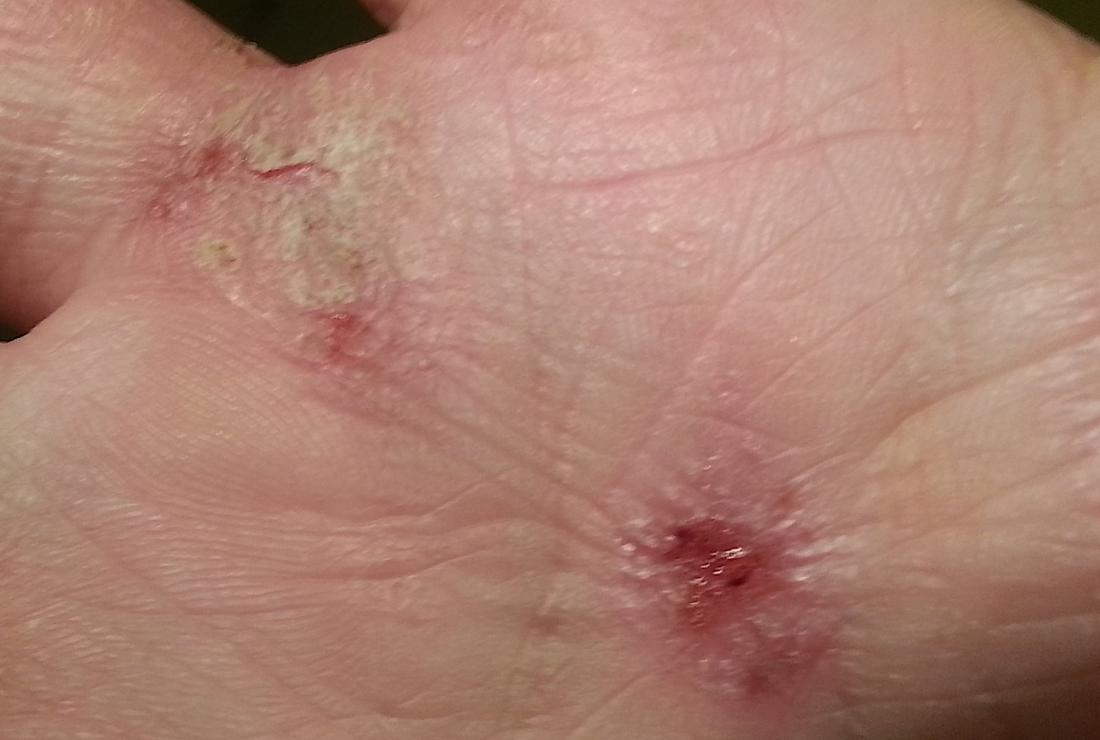 Eczema. Image credit: Assianir, 2013.