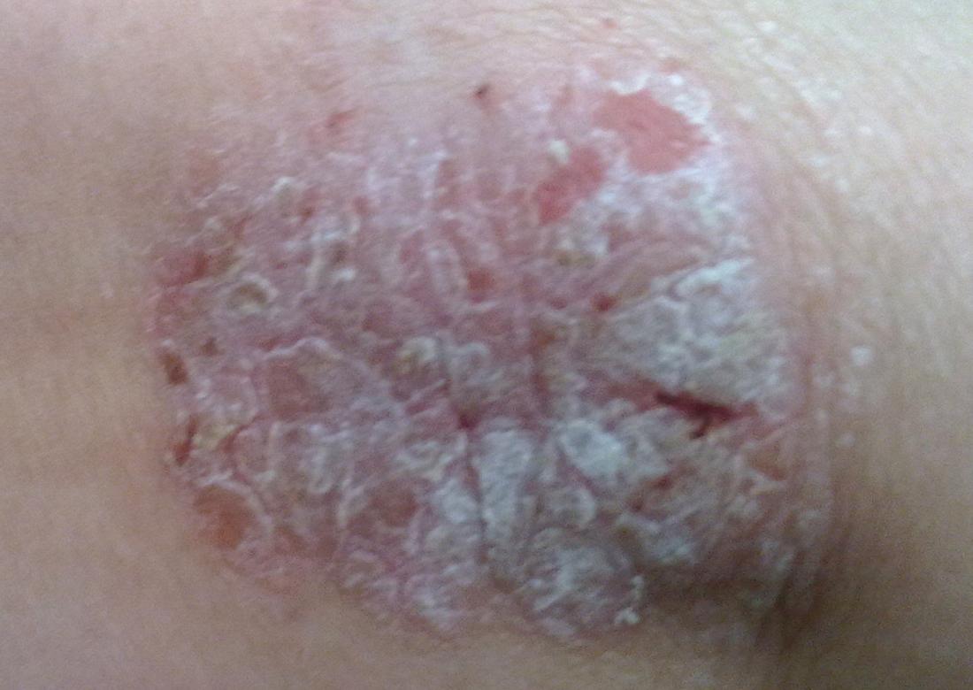 white patch of skin on knee