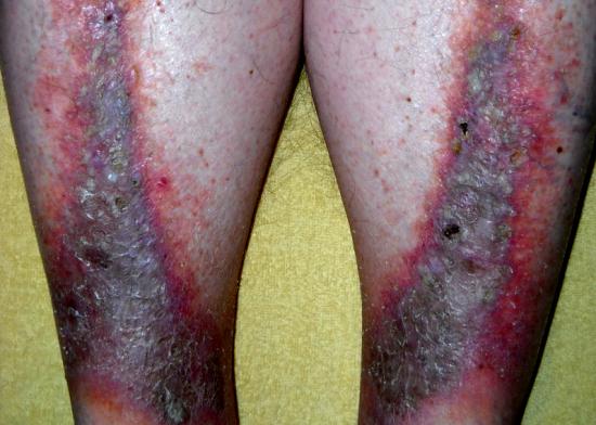 Stasis dermatitis. Image credit: Cardiologist61, 2013.