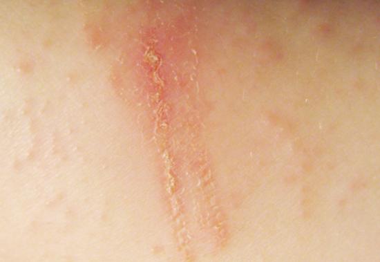 Contact dermatitis. Image credit: Digitalgadget, 2007.