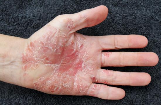 Psoriasis on hands. Image credit: Psoriasis-Netz, 2016