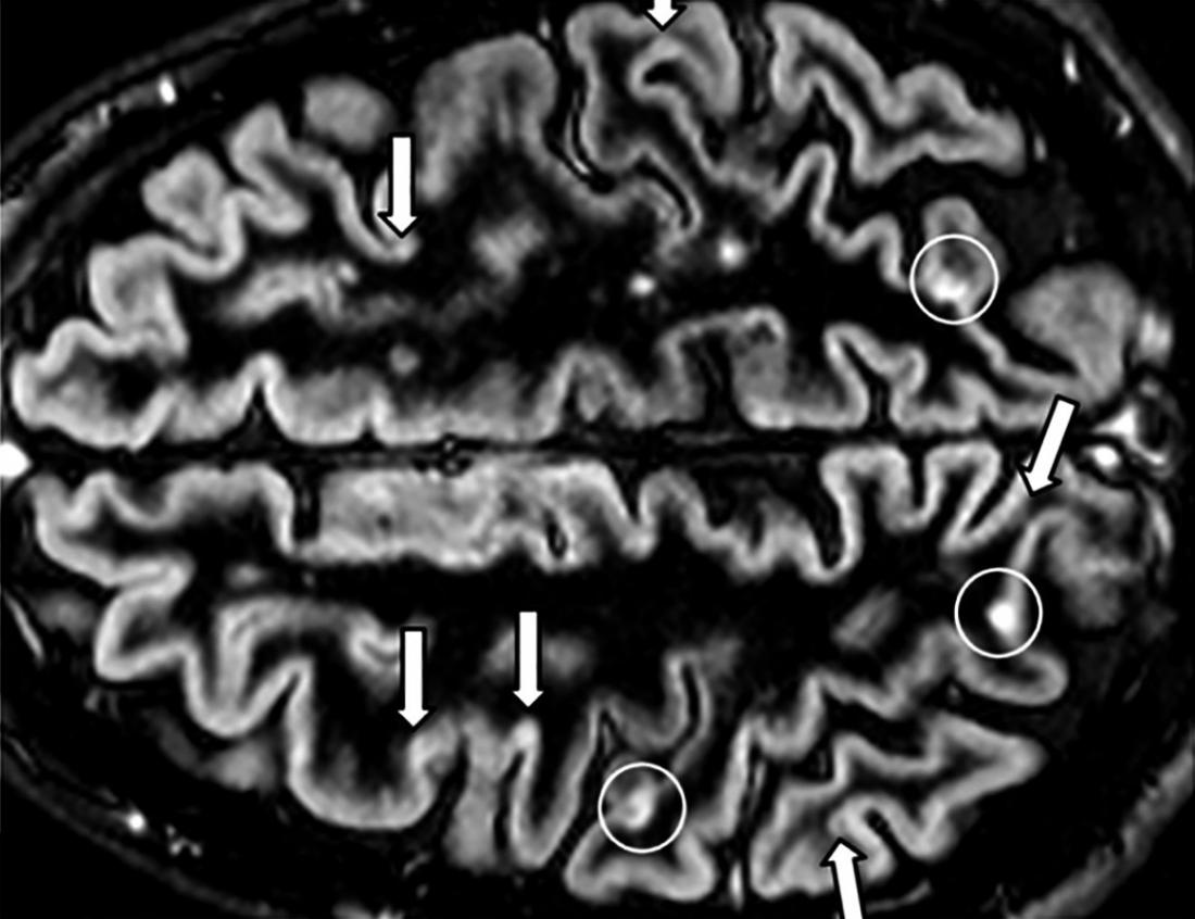 MS Brain Lesions Pictures And Prognosis