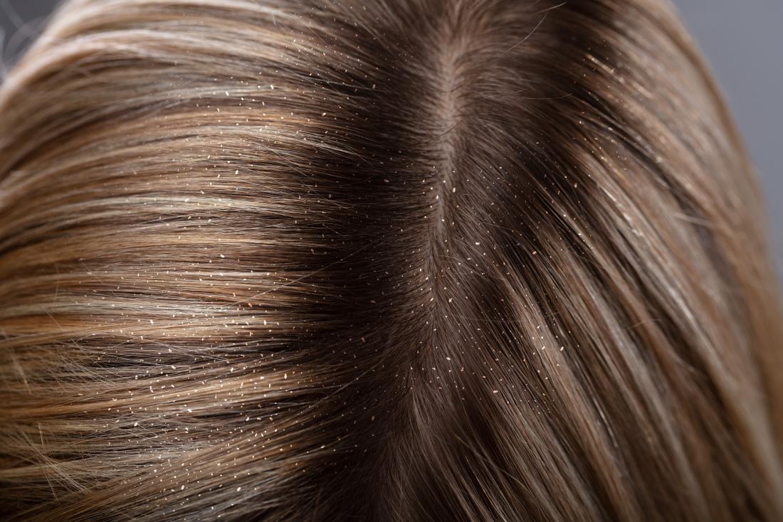 head lice eggs vs dandruff