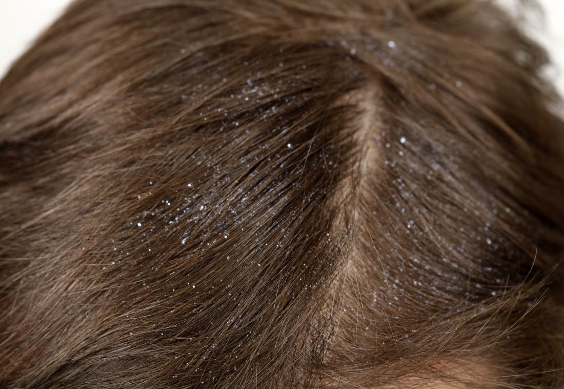 head lice eggs vs dandruff