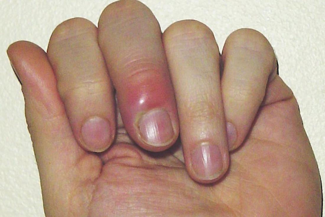 Paronychia Causes And Treatment Of An Infected Nail