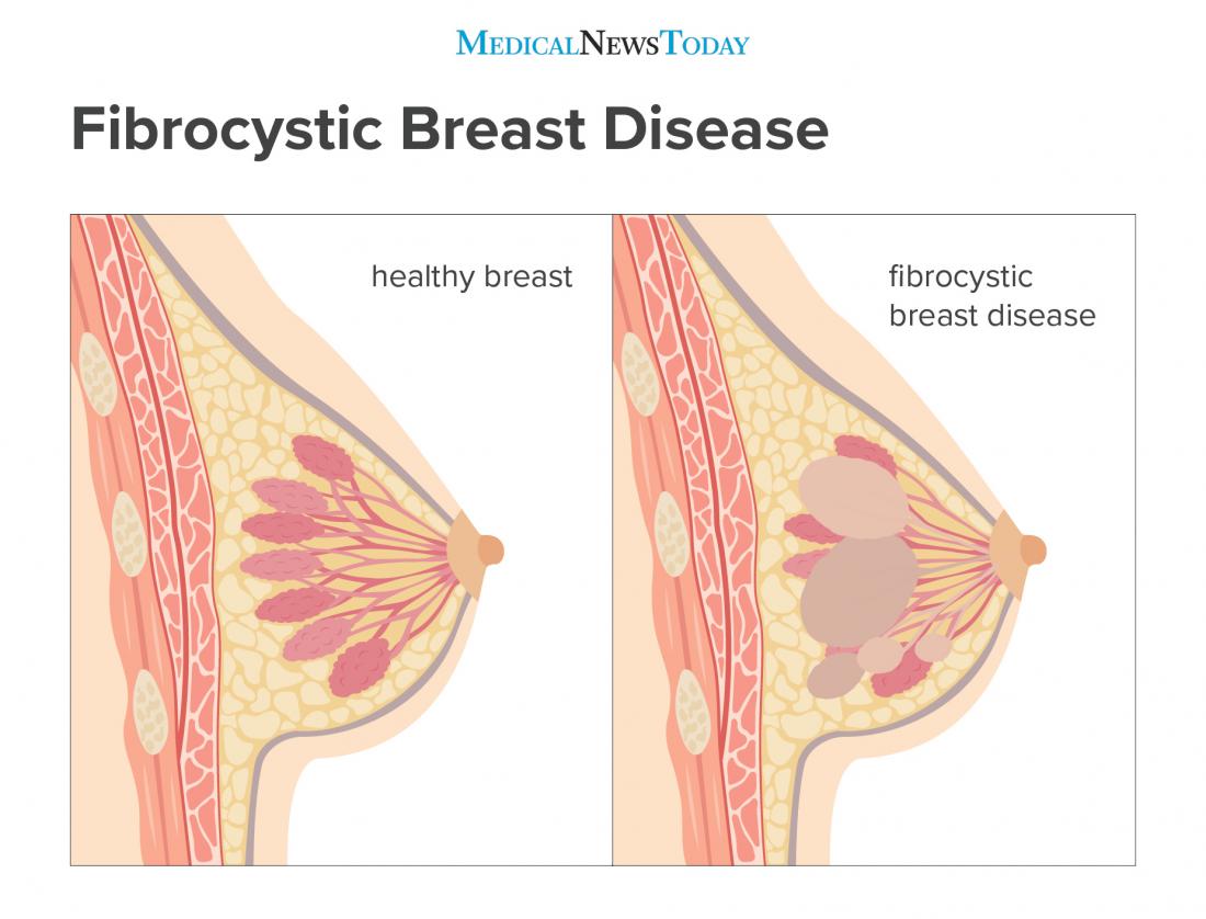 fibrocystic breast disease infographic