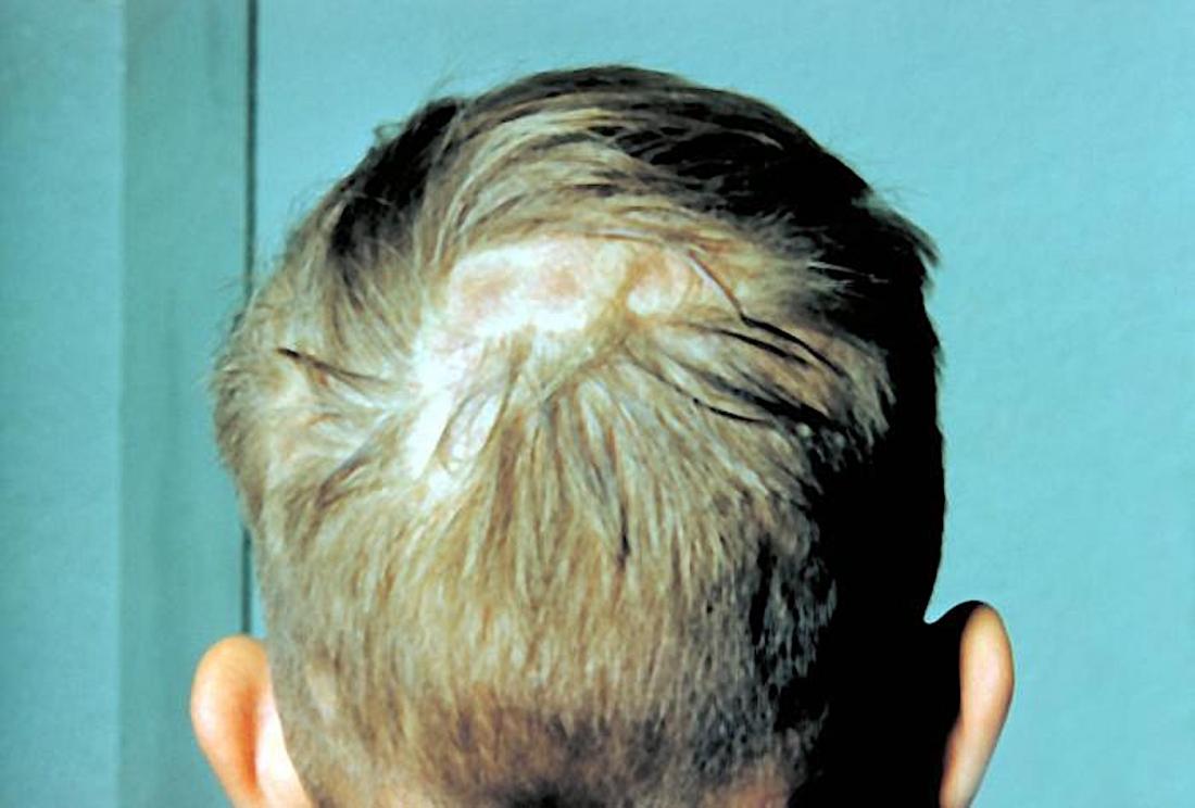 Scalp infections: Causes, symptoms, treatments, and pictures
