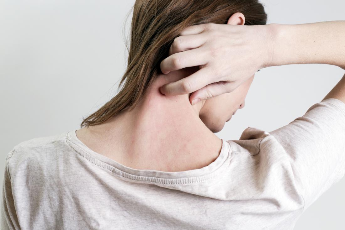 Castor oil for psoriasis itching