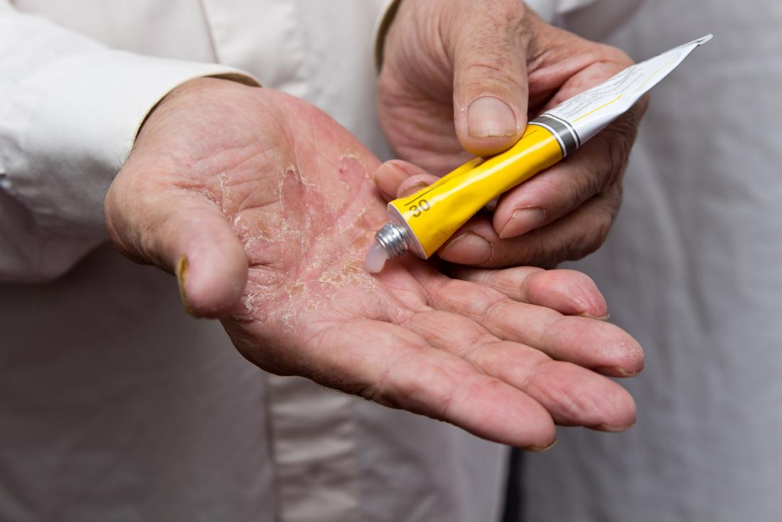 Man puts cream onto his hand for psoriasis