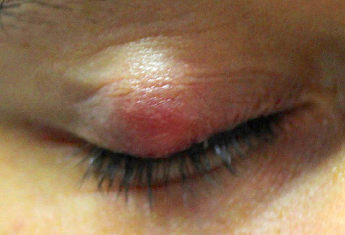 Chalazion Pictures Causes And Treatment