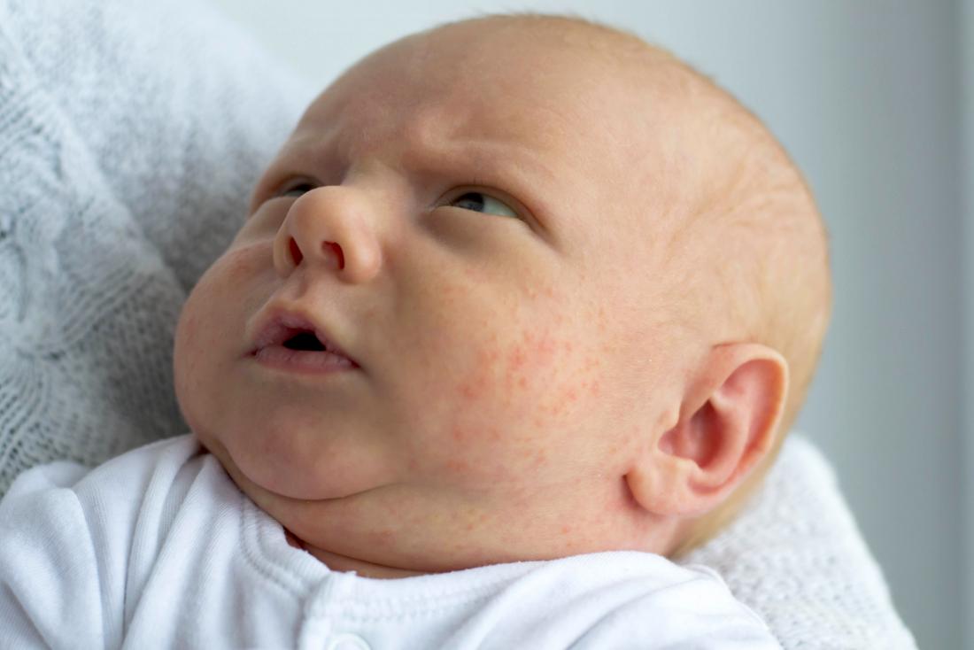 Baby Eczema Rash On Face