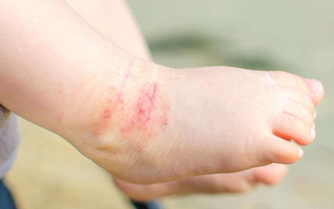 Rash on baby hands and feet