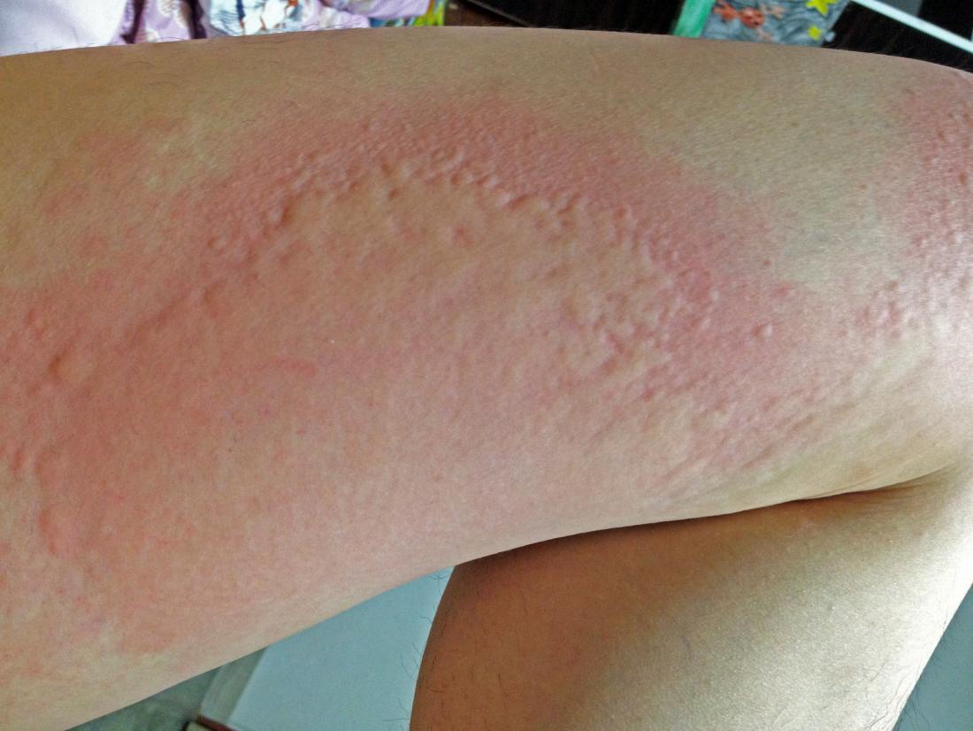 is-it-a-hepatitis-c-rash