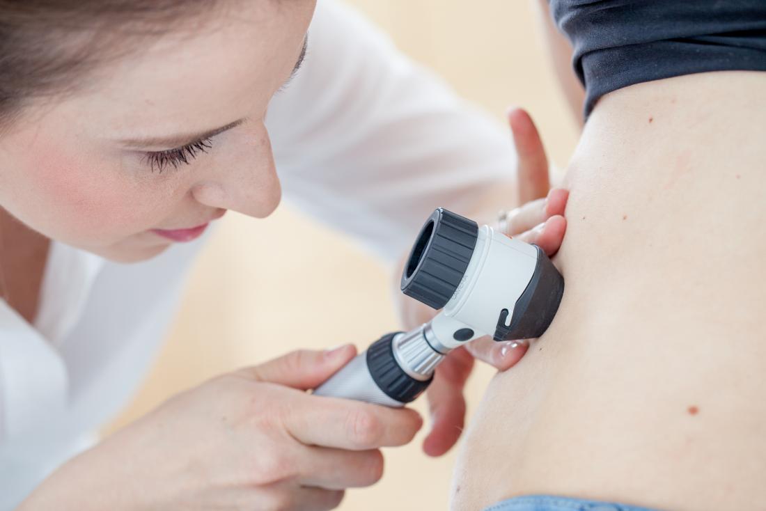 Dermatologist mole