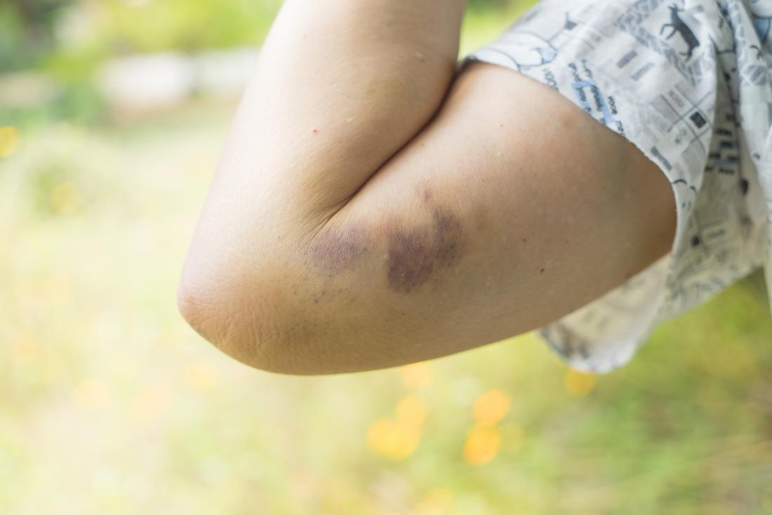 Is it OK to Exercise With a Bad Bruise?
