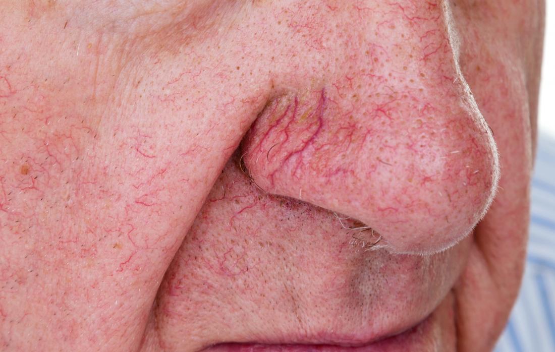 Spider vein on nose