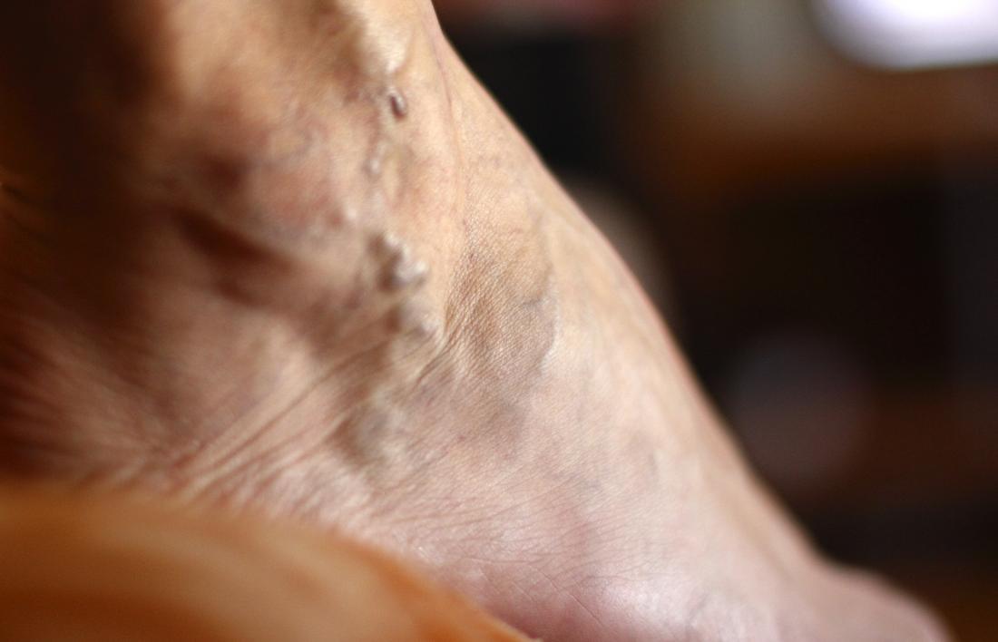 Varicose veins in foot