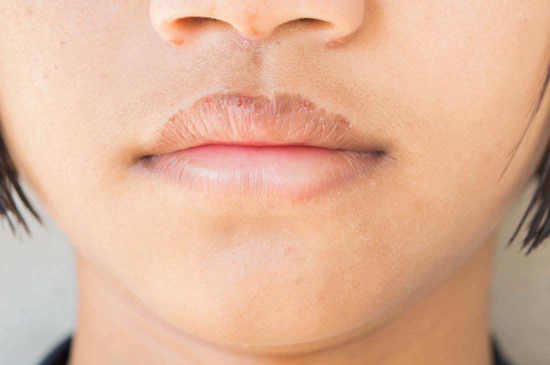 How get rid of chapped lips: 6