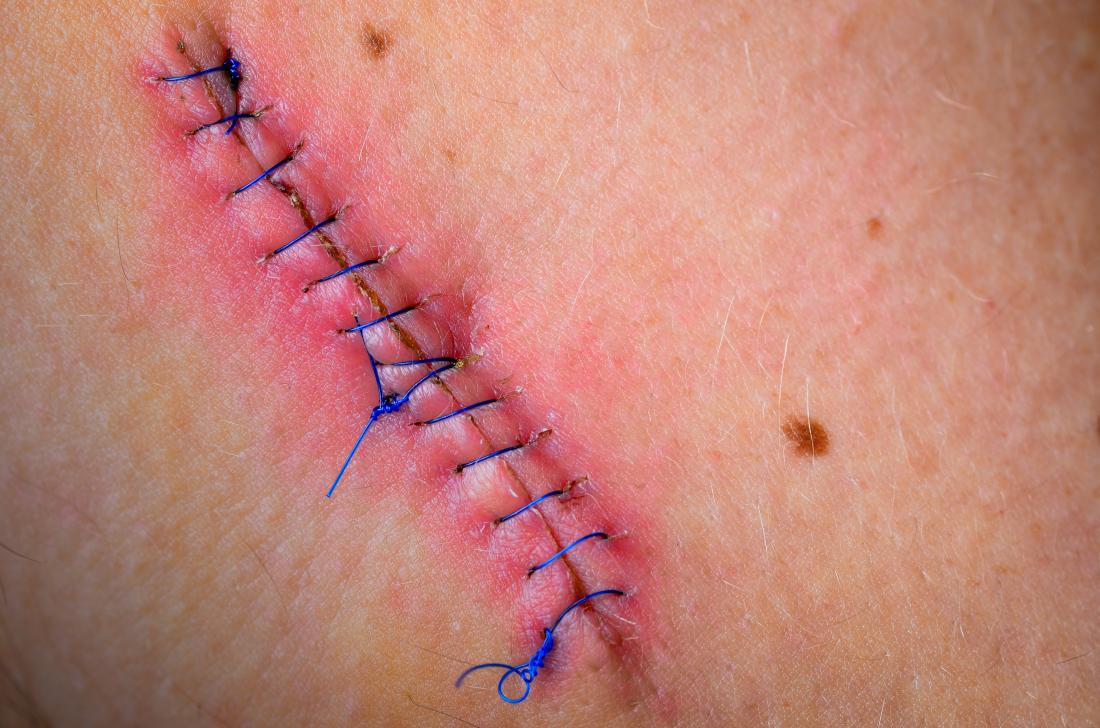 Baseball sutures or stitches