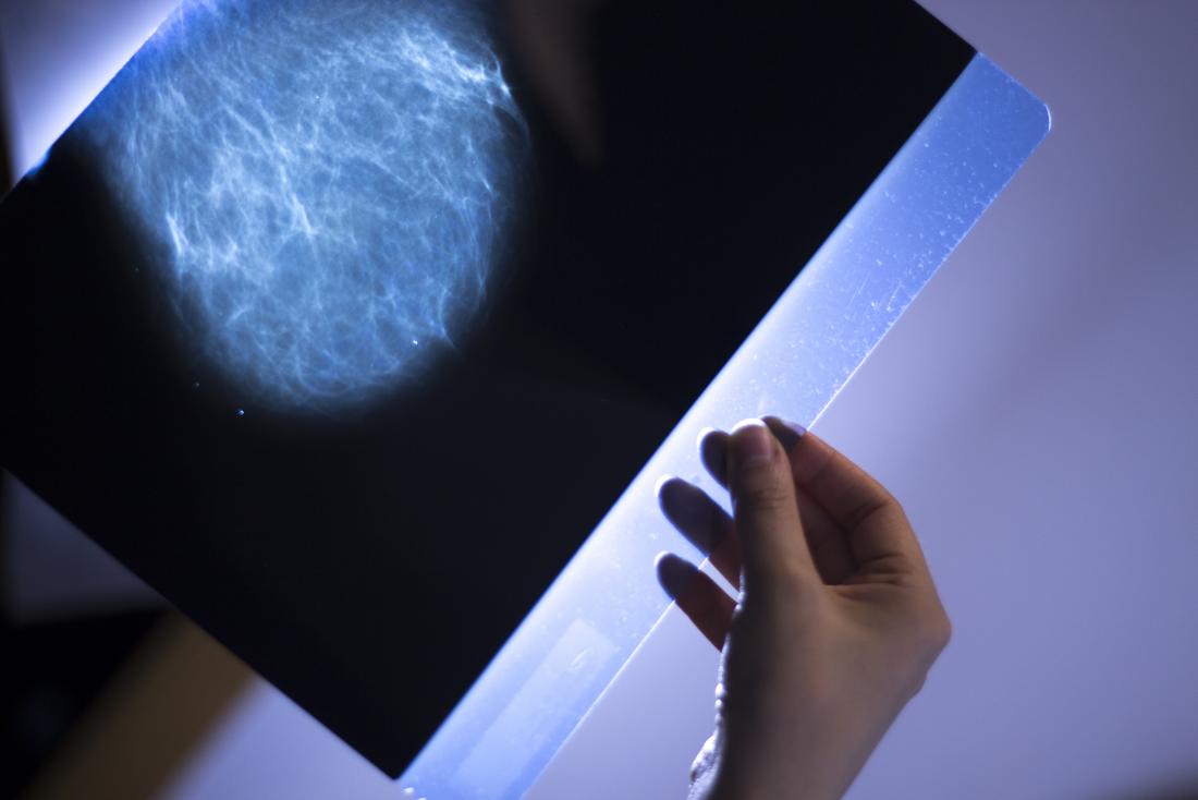 how fast can breast cancer spread in one year