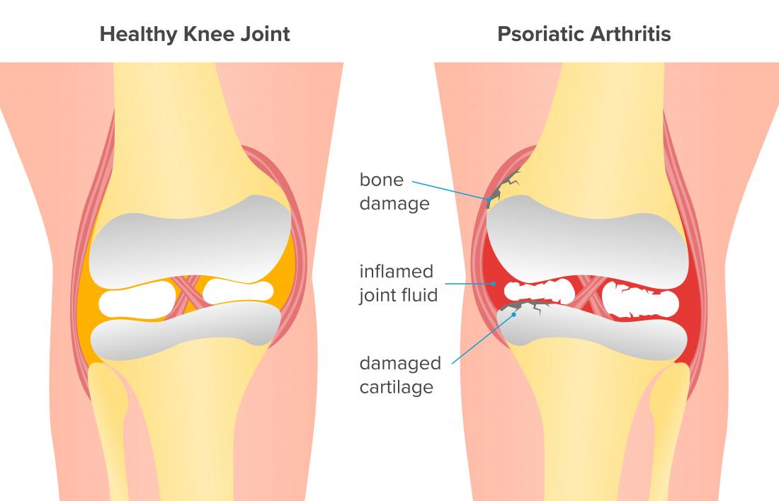 psoriatic arthritis of the knee