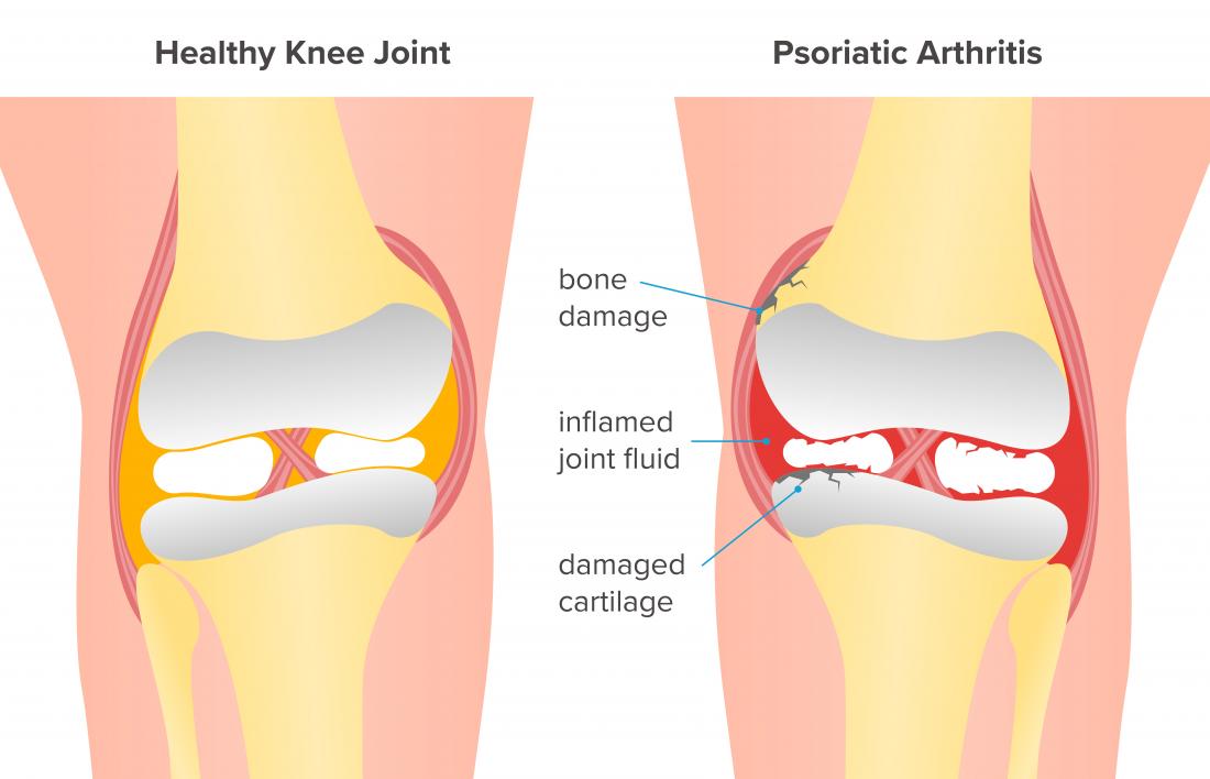 psoriasis knee