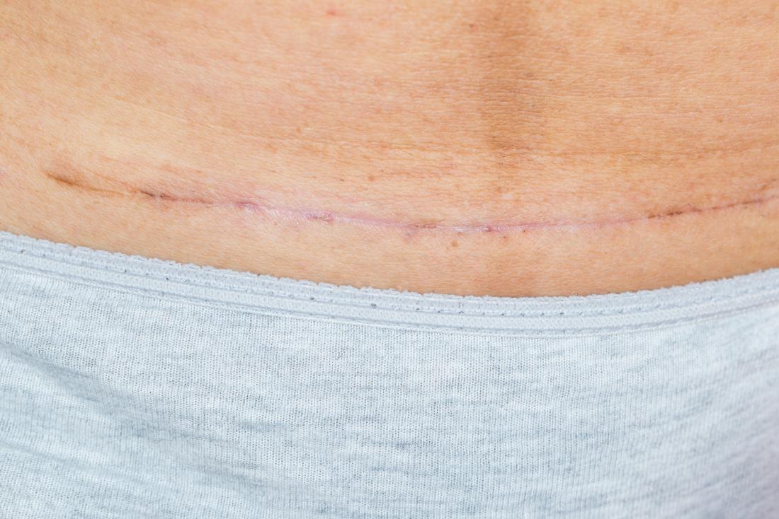 c section scar