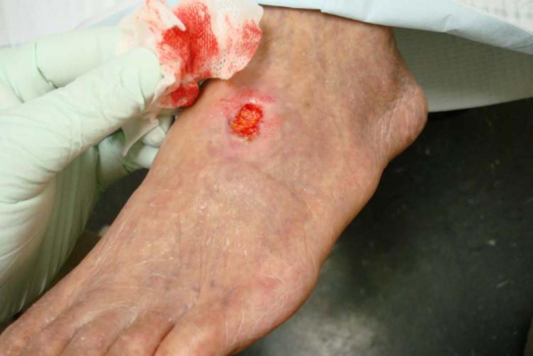 skin ulcer on finger