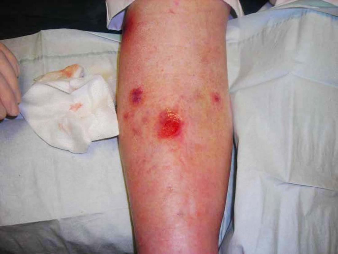 skin ulcer leg