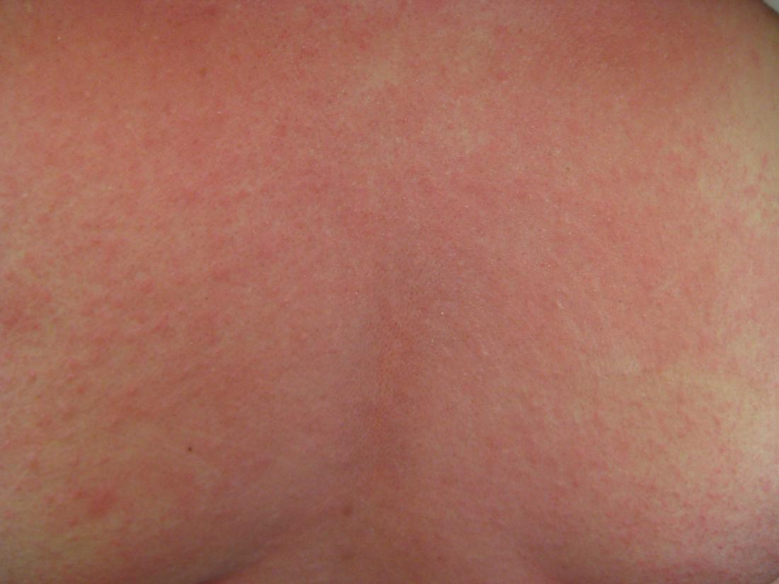 Pictures Of A Rash From Strep Throat - PictureMeta