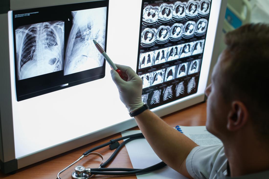 physician looking at lung xray
