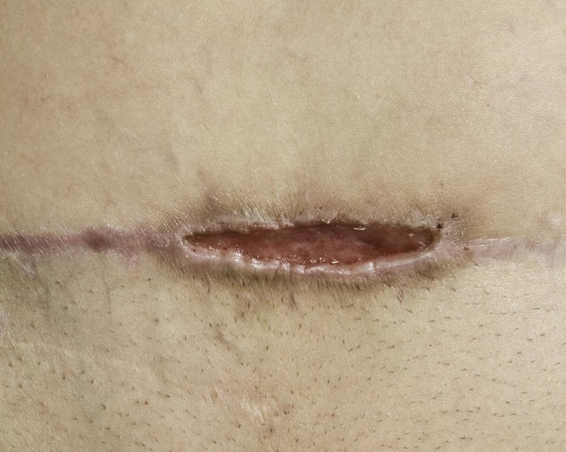 Staph Infection Incision And Drainage