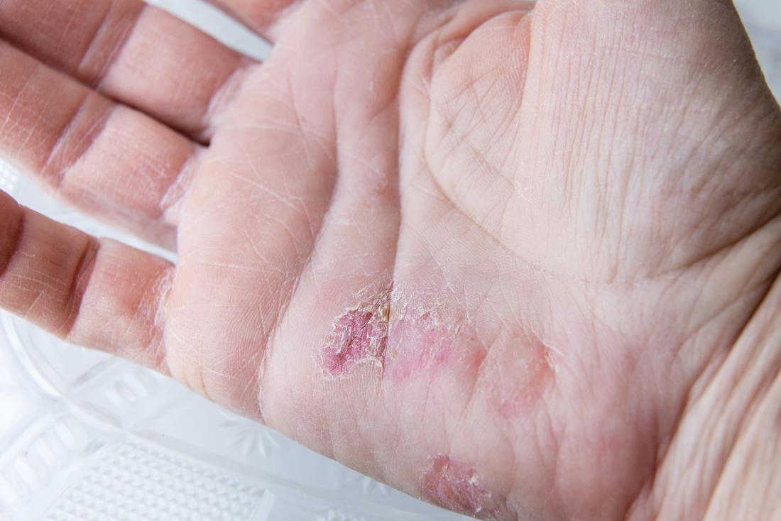 Winter rash: Causes, treatment, and prevention