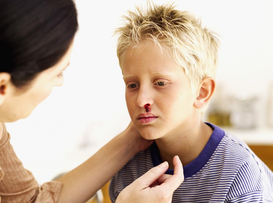 nosebleeds-in-children-when-to-see-a-doctor-causes-and-prevention