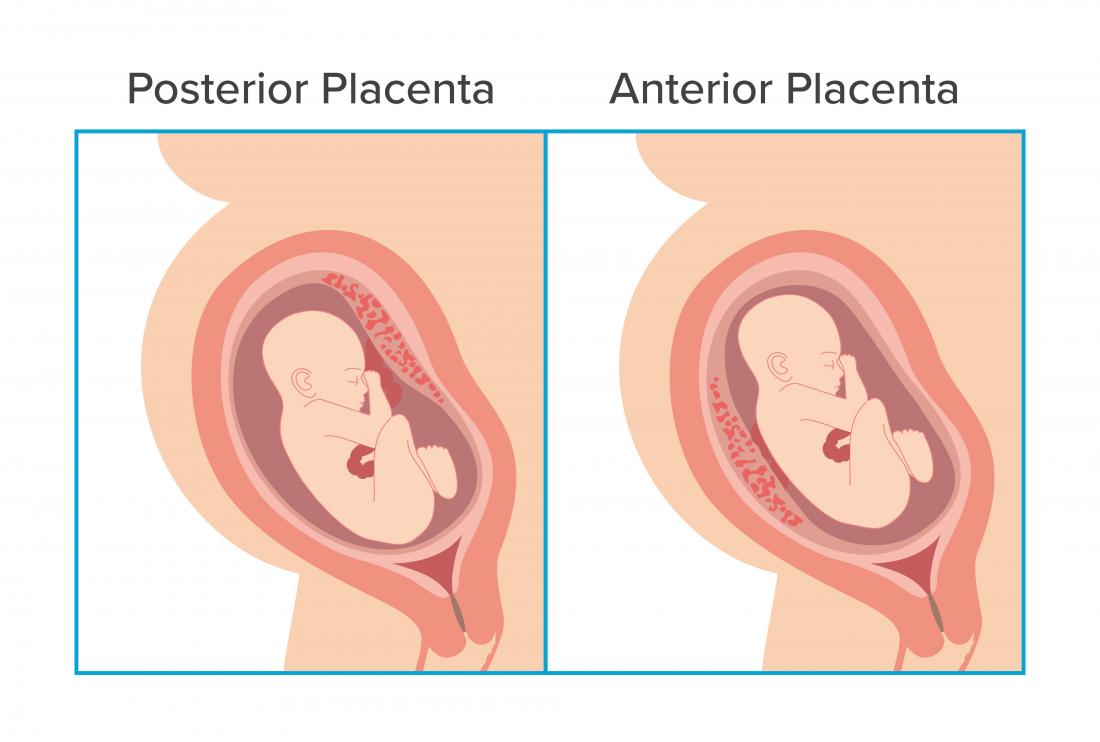 Placenta Anterior Right Lateral Means