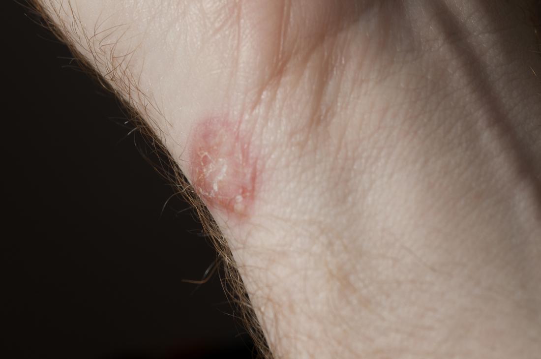 Psoriasis or ringworm? Symptoms, treatment, and other rashes