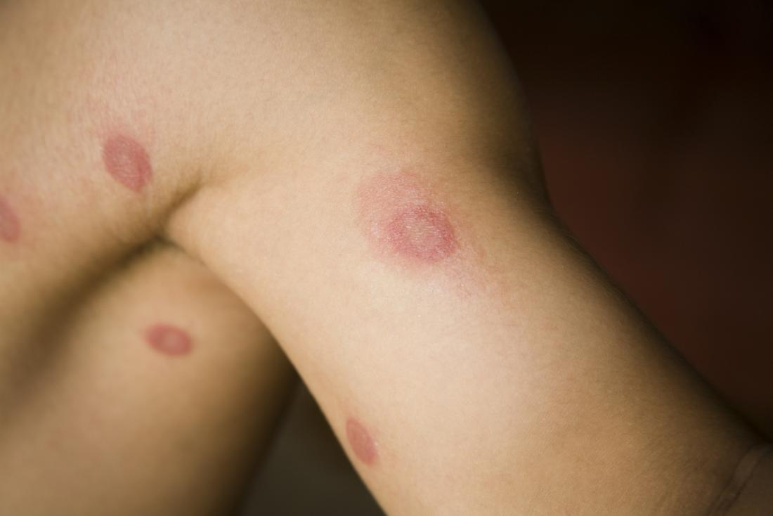 Ringworm: Treatment, symptoms, and pictures