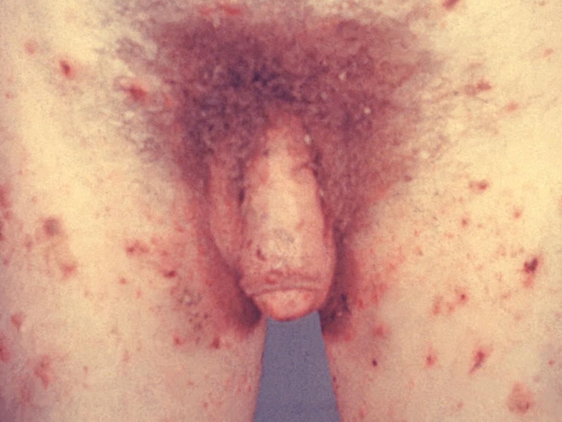 Groin scabies <br>Image credit: CDC/ Susan Lindsley, 1973</br>