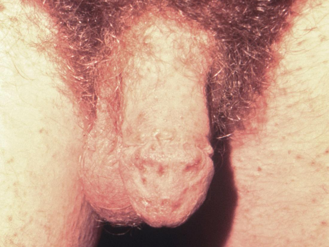 Penis with scabies <br>Image credit: CDC/ Susan Lindsley, 1976</br>