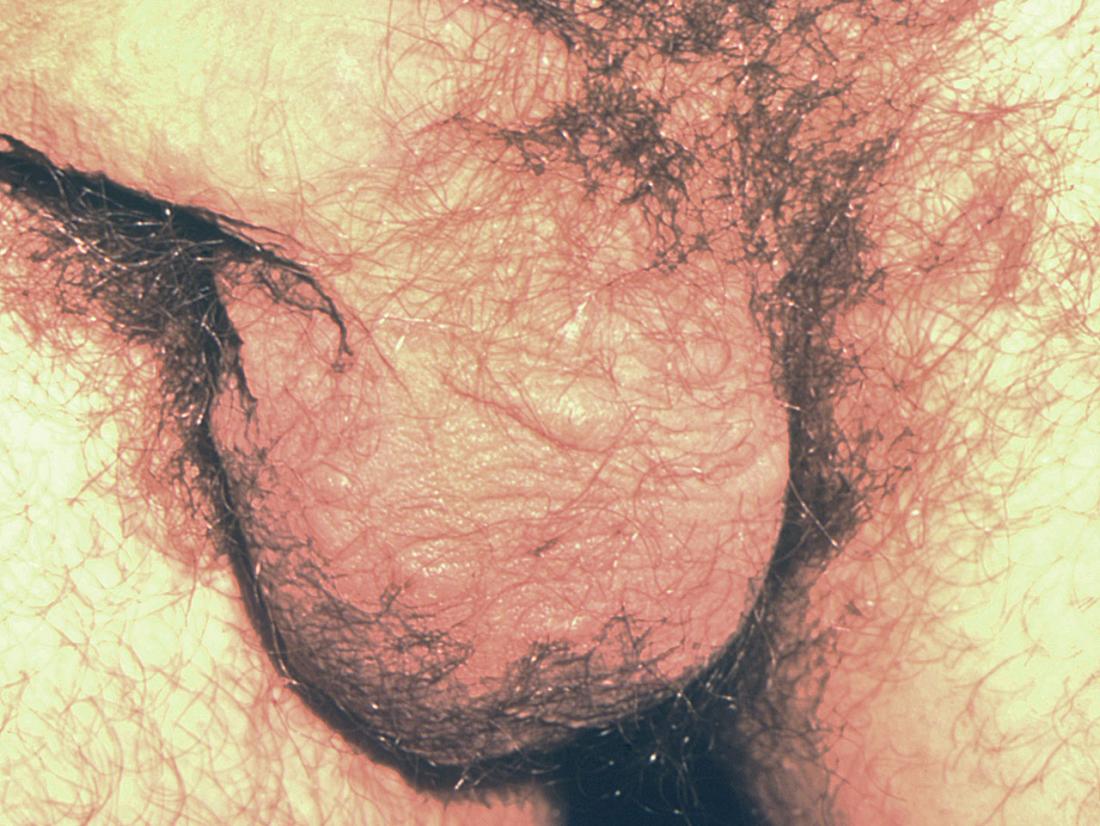Scabies on the scrotum close up <br>Image credit: CDC/ Susan Lindsley, 1976</br>
