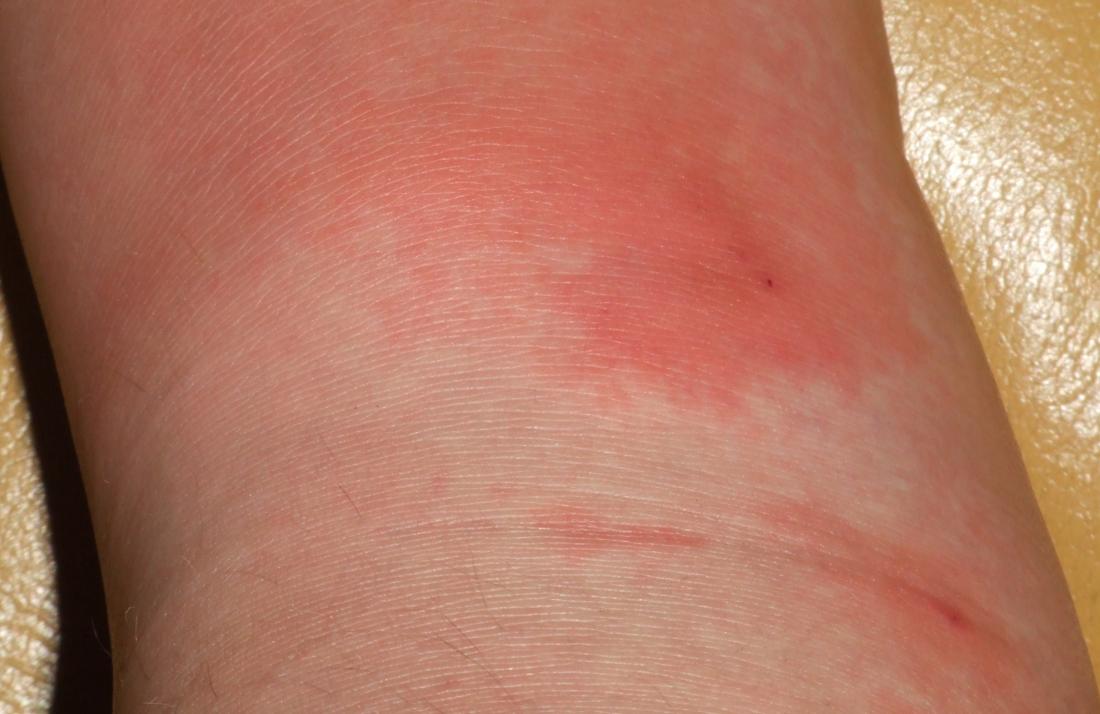 cellulitis on skin. Image credit: Poupou l'quourouce, 2006.