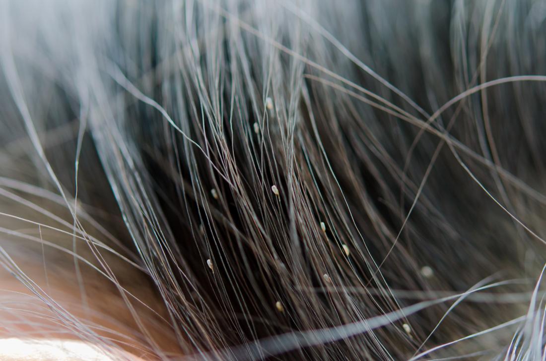 Lice in hair.