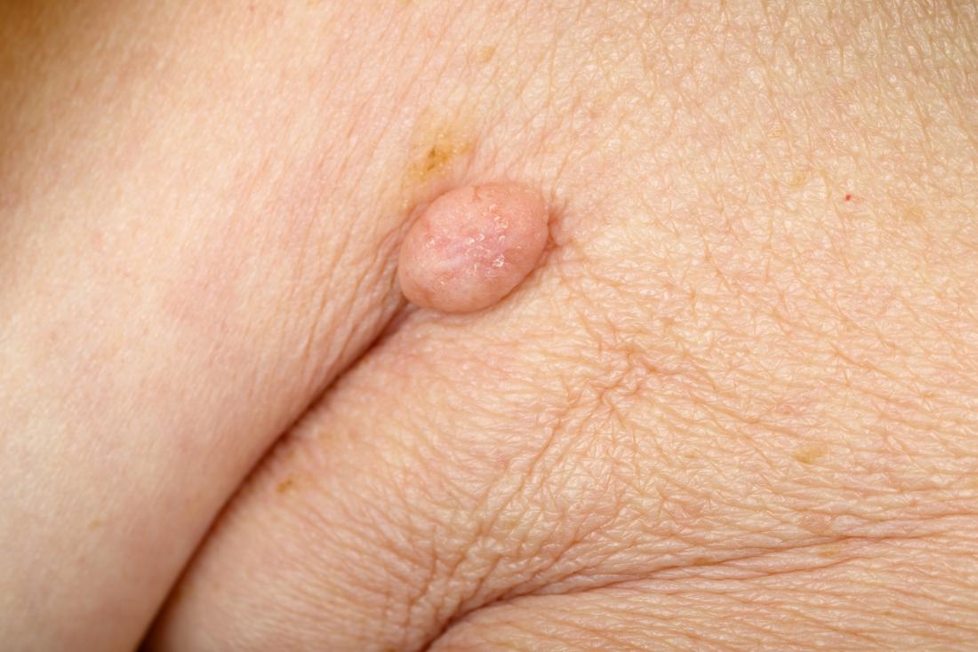 Skin Infection Pictures And Treatments