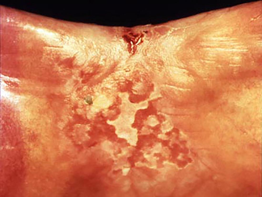 Erythroplakia <br>Image credit: BodyParts3D/Anatomography, 20013</br>