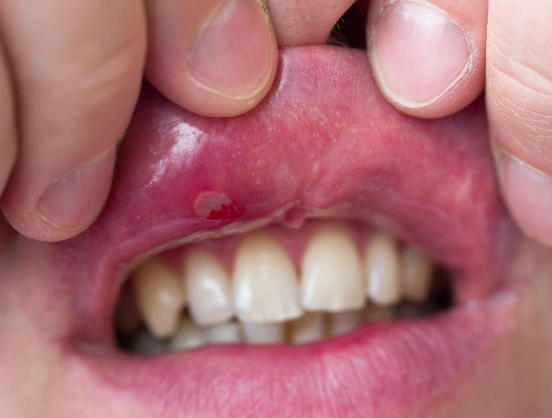 what-really-causes-canker-sores