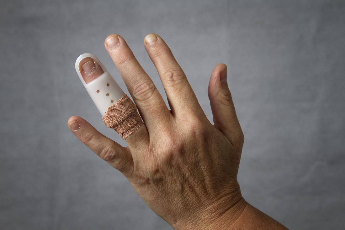 Sprained finger: Symptoms, treatment, and recovery