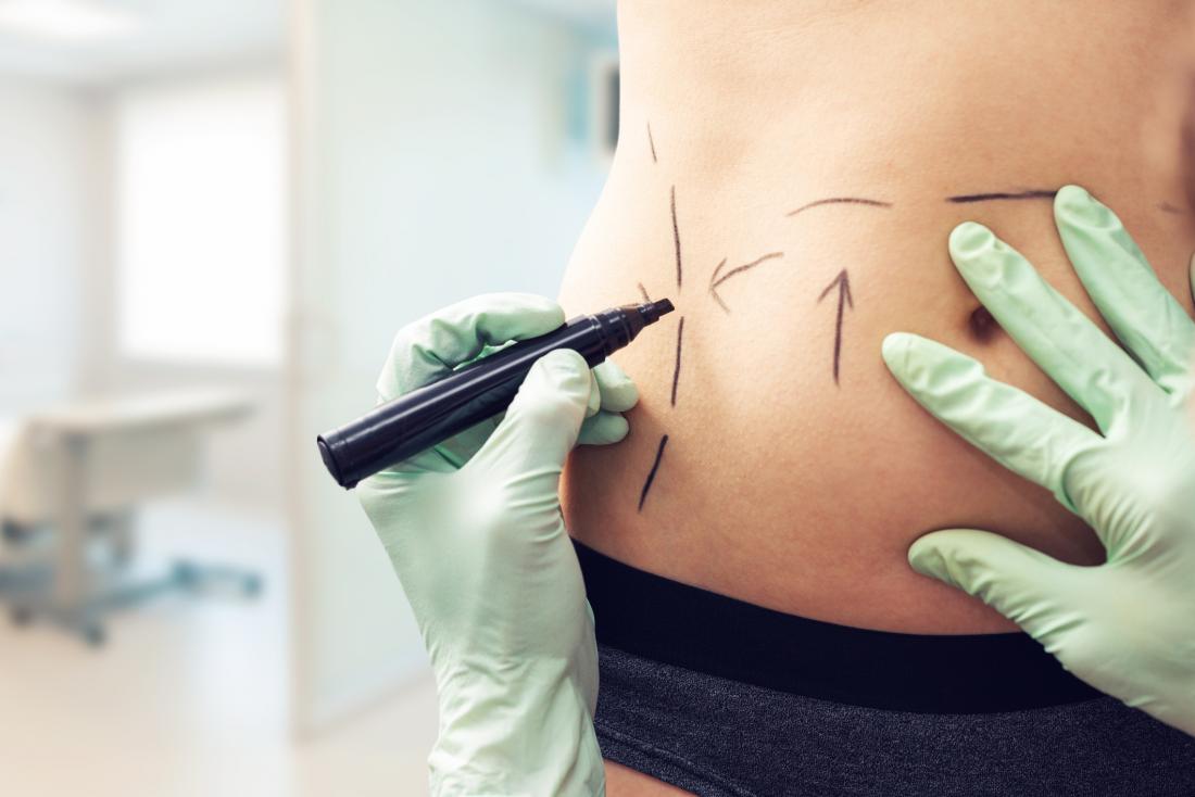 Cosmetic surgery is on the rise, new data reveal