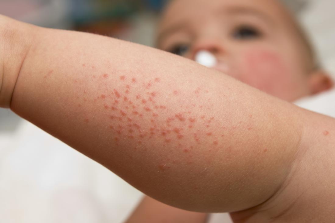 Can toddlers get heat rash on their face